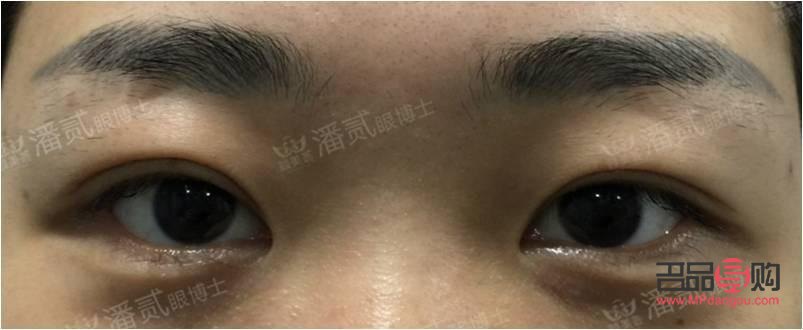 如何改善大小眼问题(如何改善大小眼问题的方法)