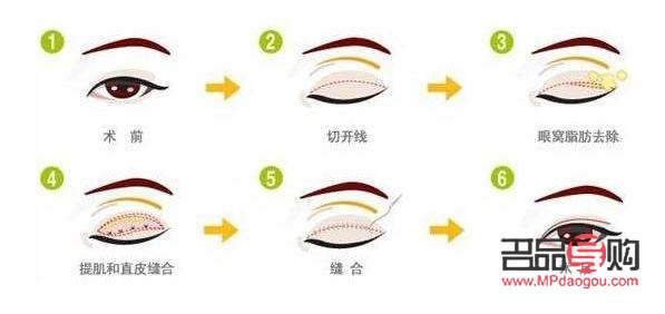 <h3>双眼皮手术恢复自然需要多久？</h3>