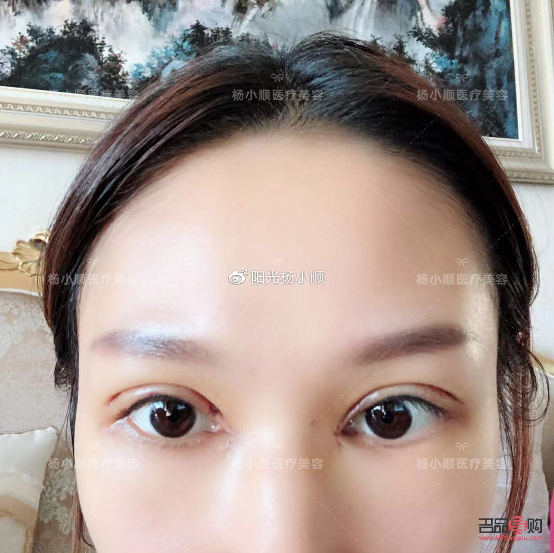 <h3>双眼皮手术恢复自然需要多久？</h3>