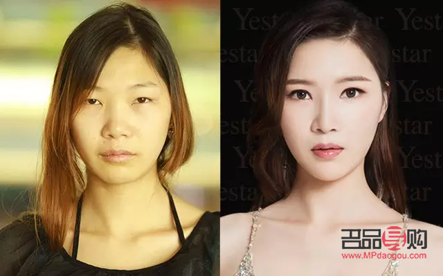 全切双眼皮免拆线弊端深度解析