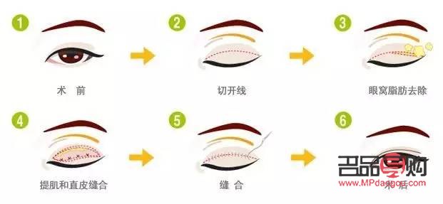 <h3>探究肿眼泡的成因及影响因素</h3>