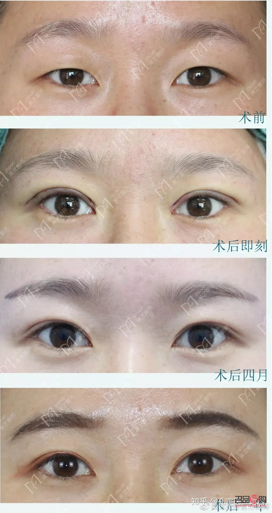 探究肿眼泡的成因及影响因素