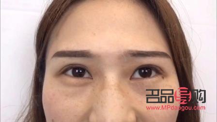 上眼睑提肌手术图解(上眼睑提肌手术图解视频)