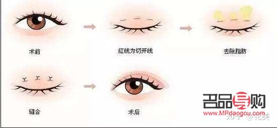 6d无痕双眼皮多久才能恢复(6d无痕双眼皮多久才能恢复自然)