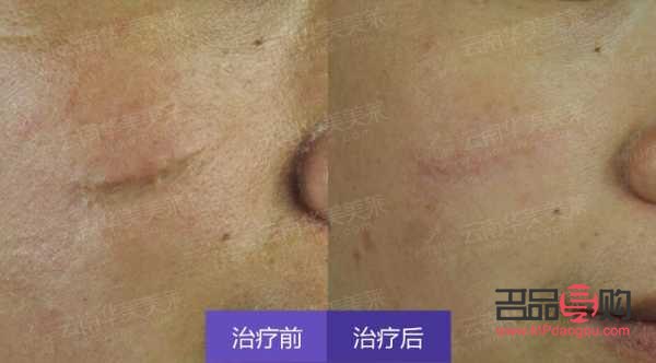 凹疤美容有用吗(凹疤美容有用吗图片)