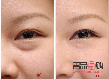 眼袋怎么消除最快(眼袋怎么消除最快最有效)