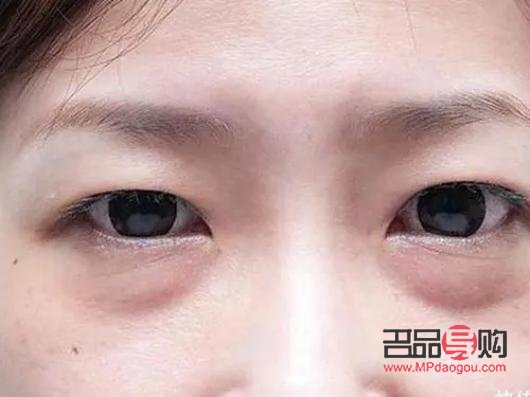 眼袋怎么消除最快(眼袋怎么消除最快最有效)