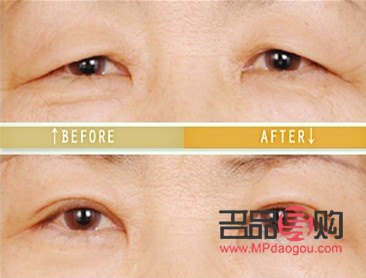 眼皮下垂做提眉还是双眼皮好(眼皮下垂做提眉还是双眼皮好看)