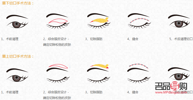 探究上眼皮松弛的成因及影响