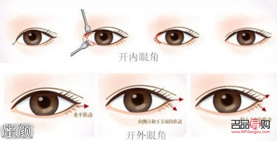 开眼角手术是否能让眼睛变大？