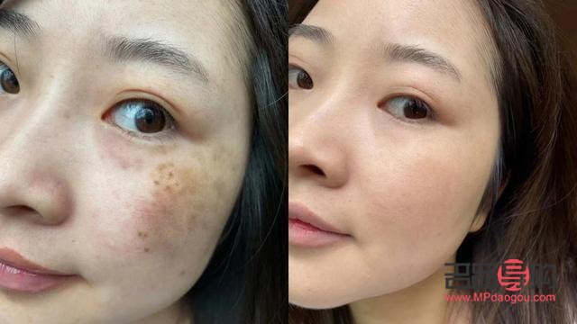 去斑美容哪里有效(去斑美容哪里有效果)
