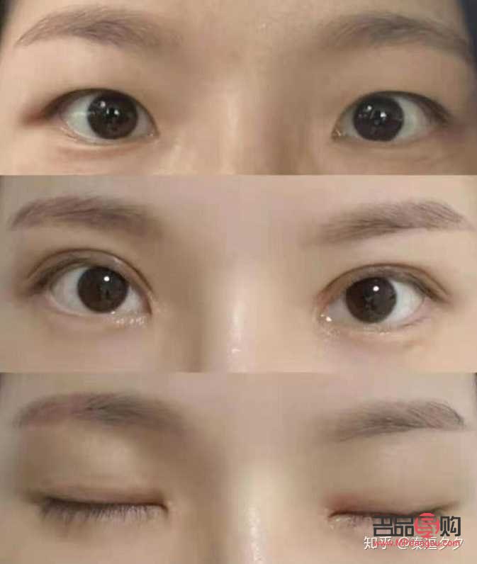 割双眼皮与自然双眼皮(割双眼皮与自然双眼皮区别)