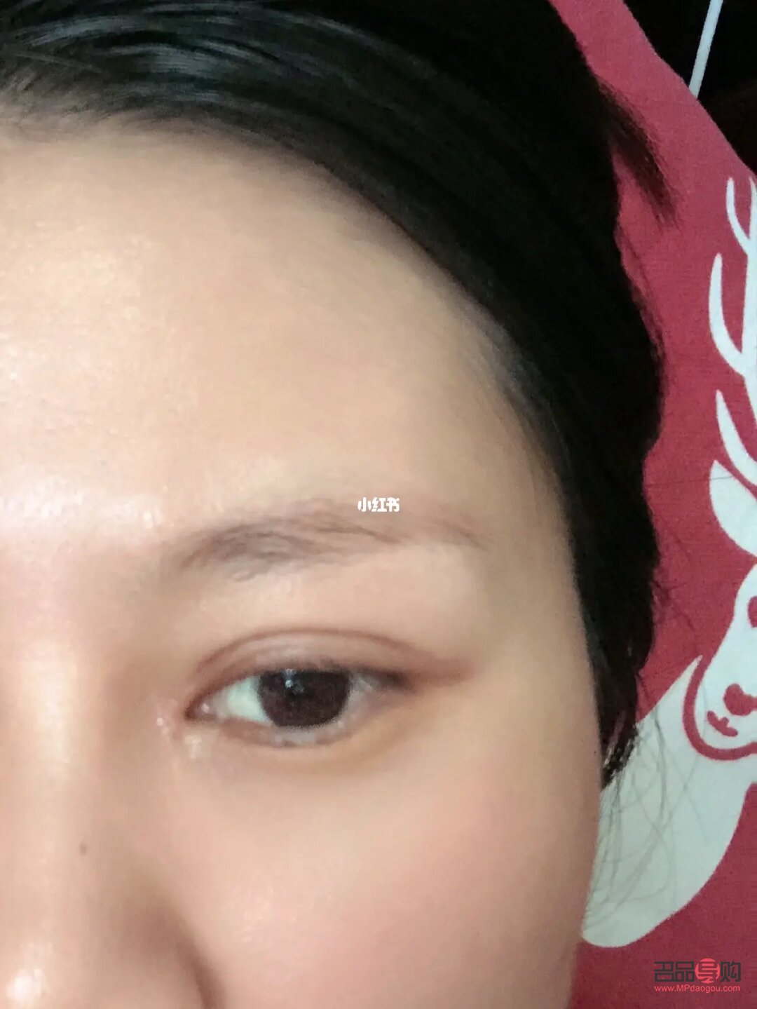 割完双眼皮眼皮有褶皱(割完双眼皮眼皮有褶皱怎么办)