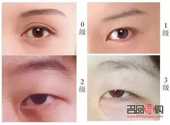 内眼角开太大会有什么影响(内眼角开太大会有什么影响嘛) 内眼角开太大会有什么影响(内眼角开太大会有什么影响嘛)