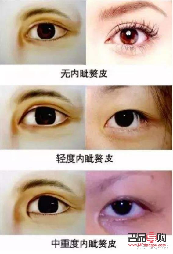 内眼角开太大会有什么影响(内眼角开太大会有什么影响嘛) 内眼角开太大会有什么影响(内眼角开太大会有什么影响嘛)