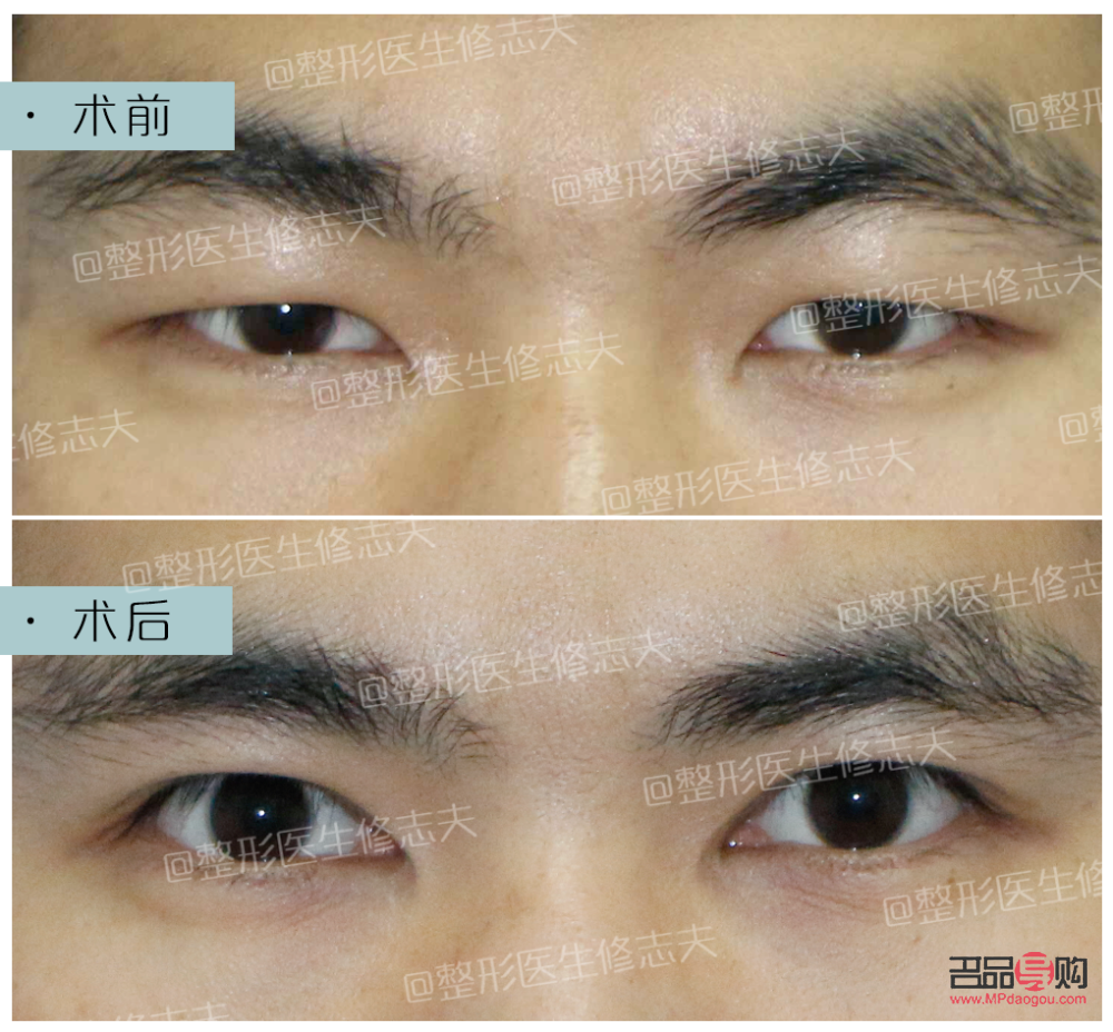 内眼角开太大会有什么影响(内眼角开太大会有什么影响嘛) 内眼角开太大会有什么影响(内眼角开太大会有什么影响嘛)