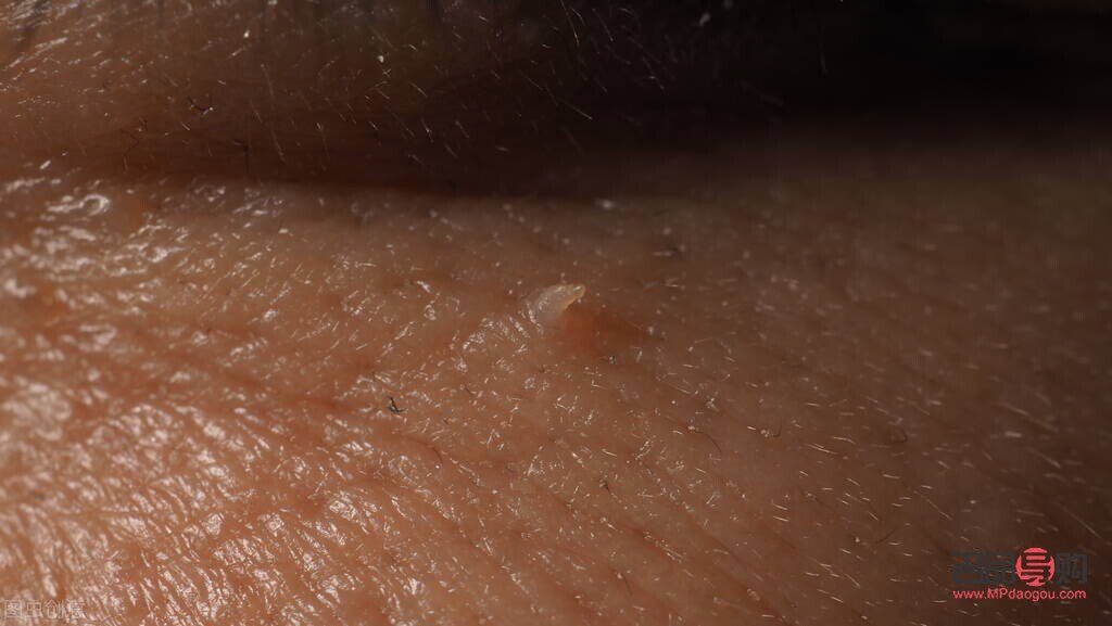 <h3>眼睑长疣：成因、症状与治疗全解析</h3>