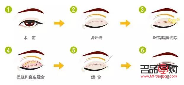 双眼皮翘睫手术原理详解