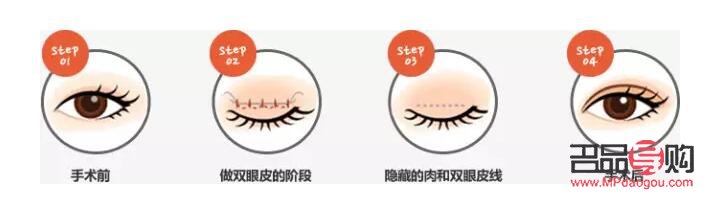 双眼皮翘睫手术原理详解