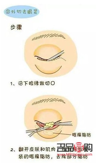 <h3>卧蚕与眼袋的区别详解——图解对照，一目了然</h3>