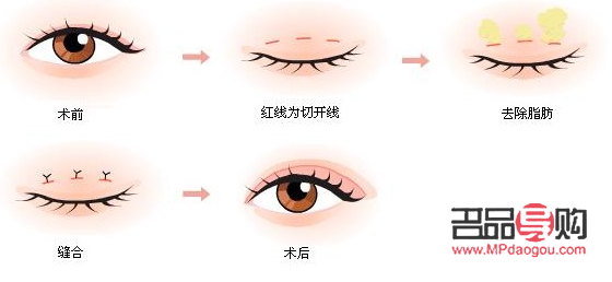 肉眼泡做双眼皮手术是否需要抽脂？
