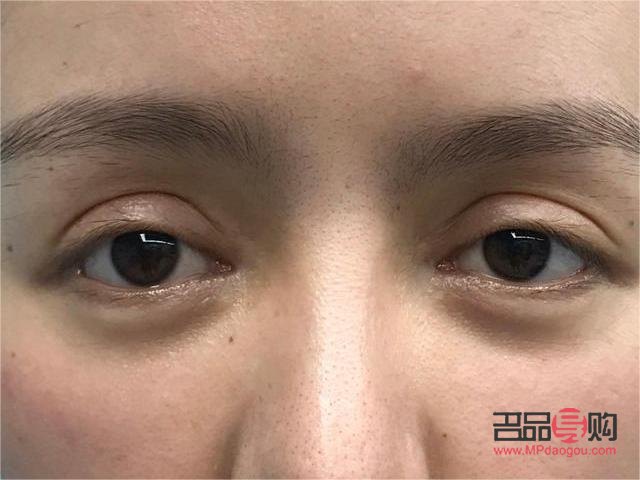 双眼皮老了下垂图片(双眼皮老了会塌下来吗)