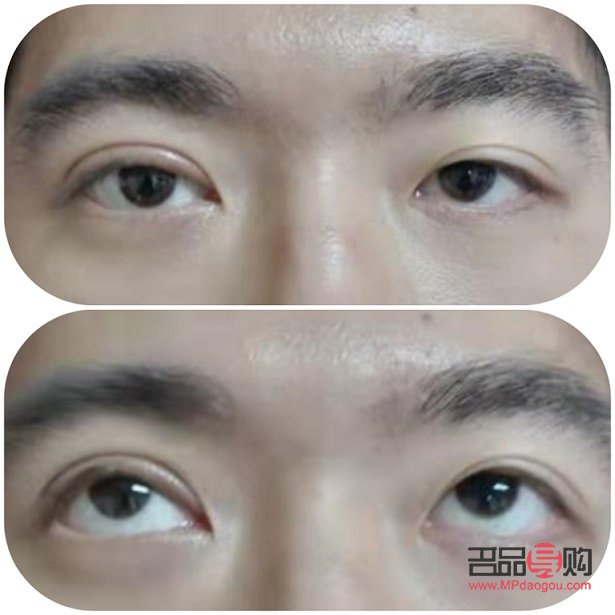 眼皮肌无力做双眼皮可以改善吗(眼皮肌无力做双眼皮可以改善吗图片)