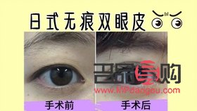 日式无痕双眼皮是什么原理(日式无痕双眼皮是什么原理做的)