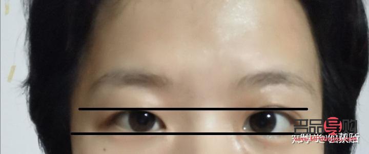 眼睛一大一小怎么纠正多少钱(眼睛一大一小怎么改)