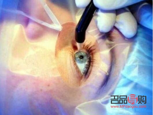 眼球矫正(眼球矫正手术大概多少钱)
