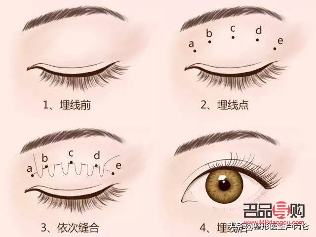 双眼皮所有类型(双眼皮所有类型图)