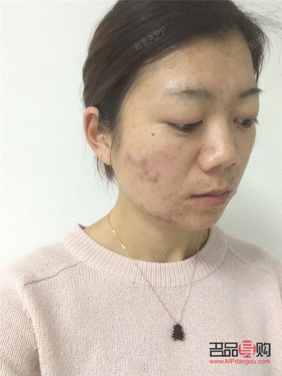 去美容院清痘好吗(去美容院清痘好吗女生)