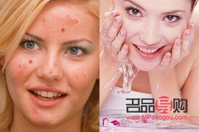 去美容院清痘好吗(去美容院清痘好吗女生)
