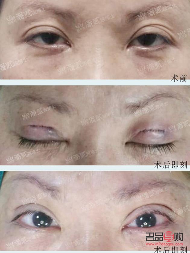 双眼皮下垂是什么原因导致的(双眼皮下垂是什么原因导致的呢)