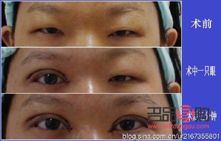 <h3>翘睫双眼皮恢复全过程图解</h3> <h3>翘睫双眼皮恢复全过程图解</h3>