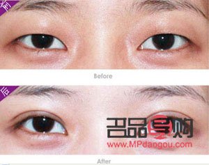 割双眼皮对以后好吗(割双眼皮对以后有什么影响吗)