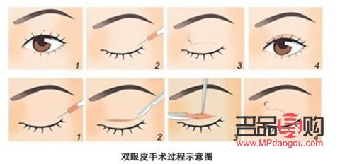 割双眼皮对以后好吗(割双眼皮对以后有什么影响吗)