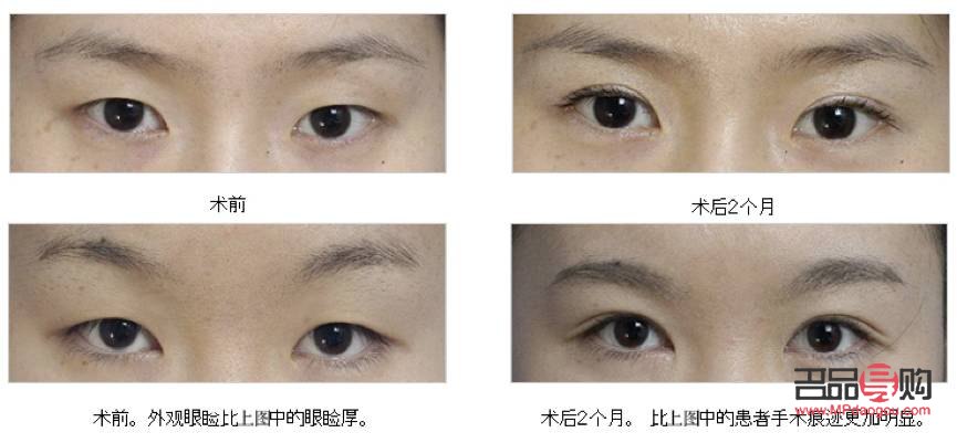 割双眼皮对以后好吗(割双眼皮对以后有什么影响吗)