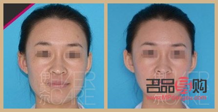 瘦脸针美容多少钱(瘦脸针美容多少钱一次)