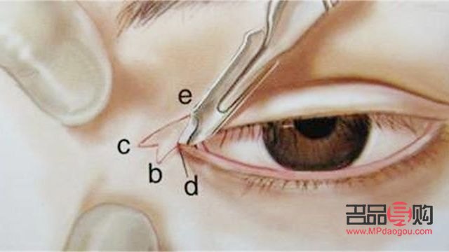 <h3>开眼角手术恢复期需知，助你快速回归正常生活</h3>