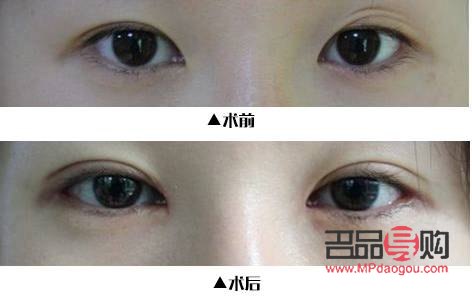 开眼角手术恢复期需知，助你快速回归正常生活