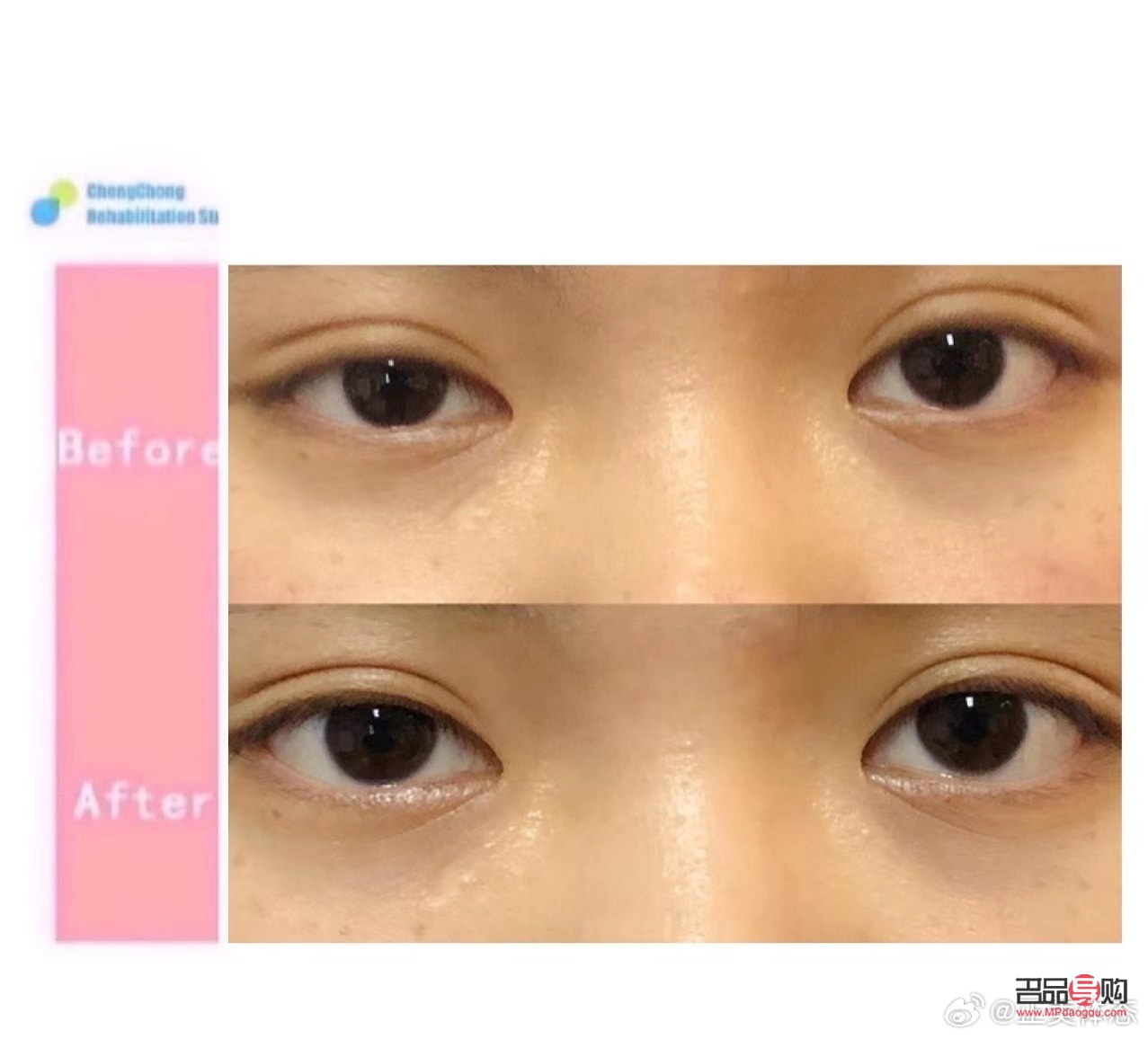 <h3>眼睛一大一小矫正费用区别详解</h3>