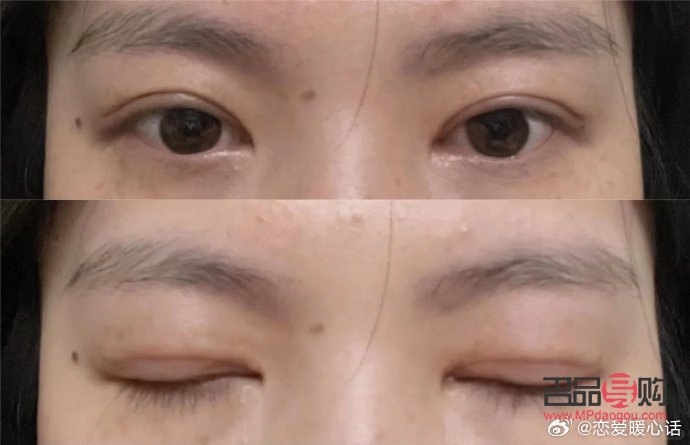 双眼皮宽改窄风险大吗(双眼皮宽改窄风险大吗图片)