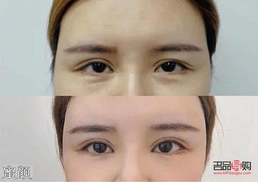 双眼皮宽改窄风险大吗(双眼皮宽改窄风险大吗图片)