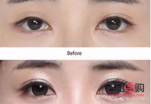 双眼皮宽改窄风险大吗(双眼皮宽改窄风险大吗图片)