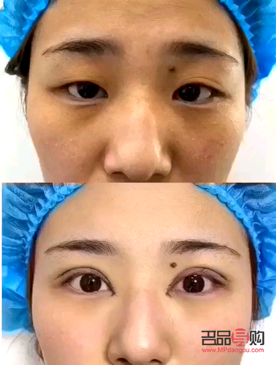 大眼综合的恢复过程(大眼综合的恢复过程是什么)