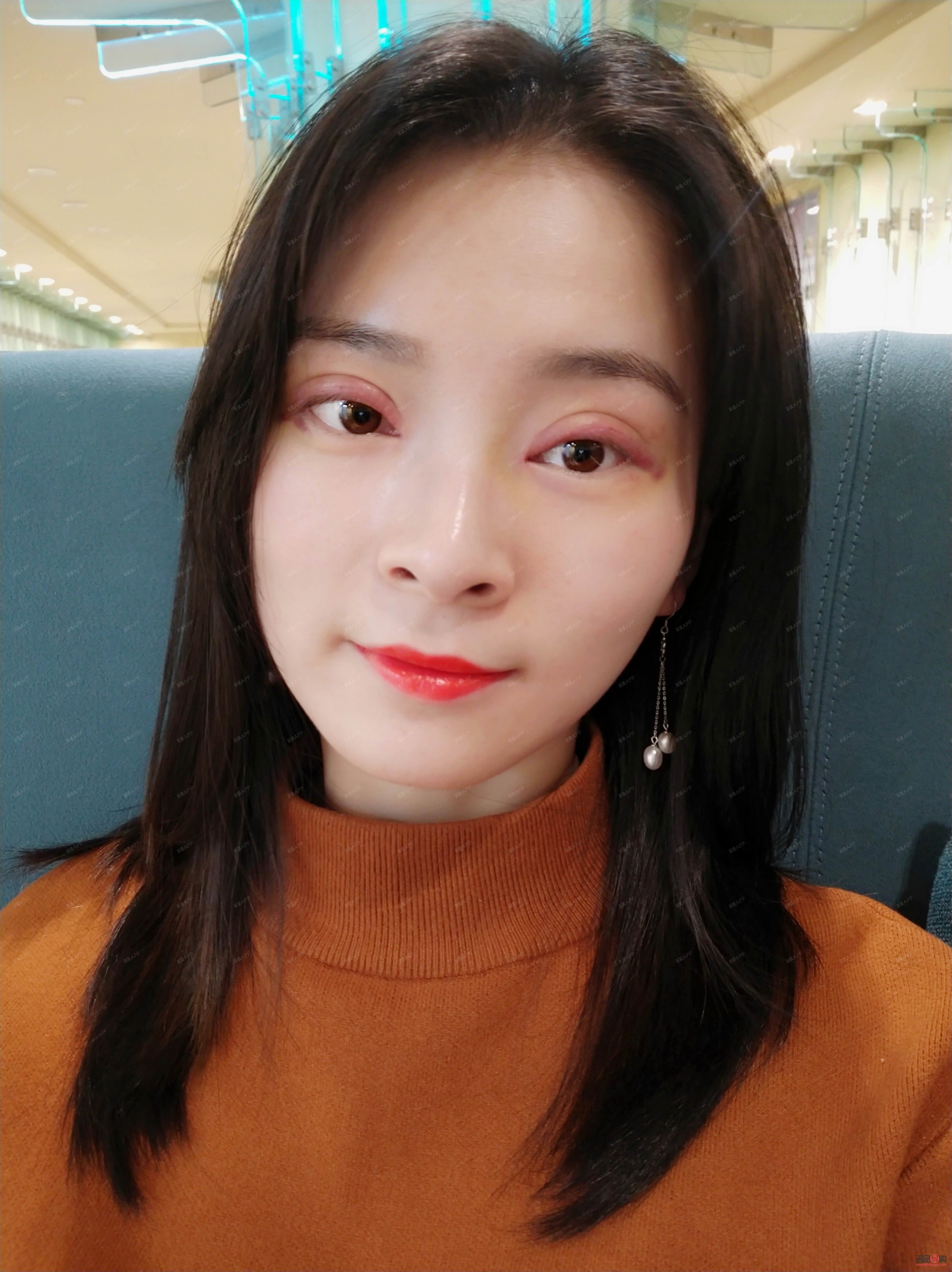 大眼综合的恢复过程(大眼综合的恢复过程是什么)