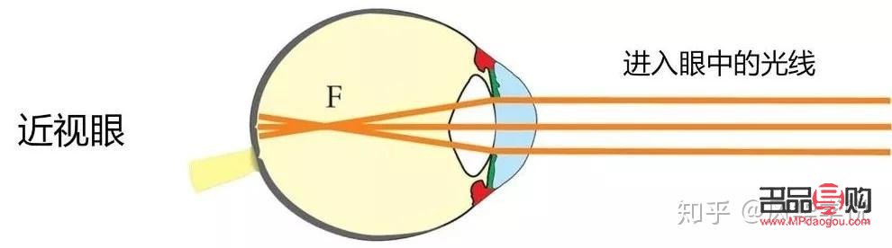 眼睛近视了怎样才能恢复正常(眼睛近视了怎样才能恢复正常的视力)