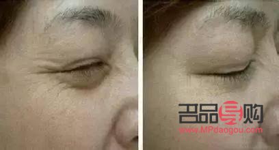 <h3>解决下眼皮松弛下垂的最佳方法</h3>
