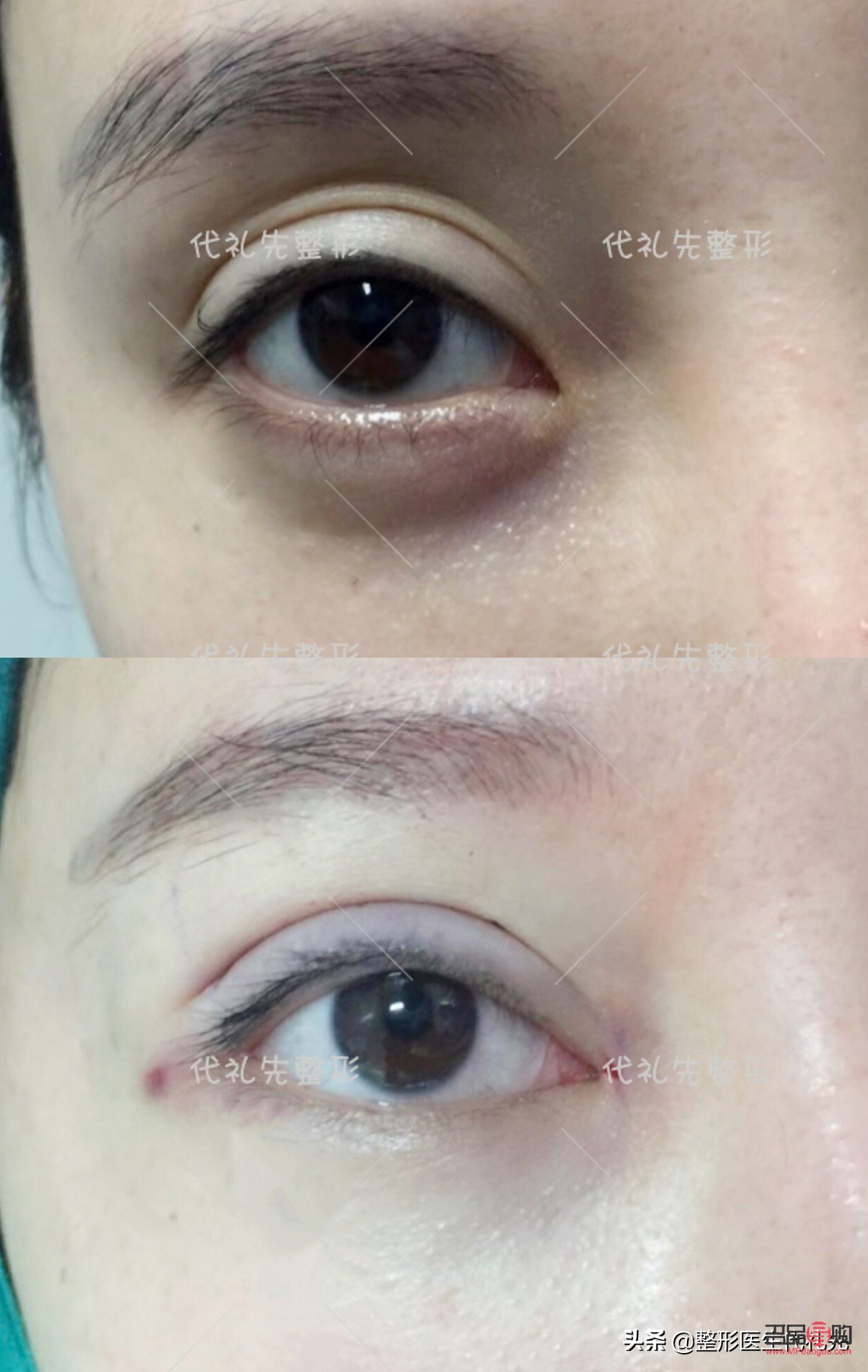 眼窝填充术大概要多少钱(眼窝脂肪填充第3天照片) 眼窝填充术大概要多少钱(眼窝脂肪填充第3天照片)